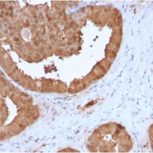 Formalin-fixed, paraffin-embedded human prostate carcinoma stained with Glyoxalase 1 (GLO1) Mouse Monoclonal Antibody (CPTC-GLO1-3).