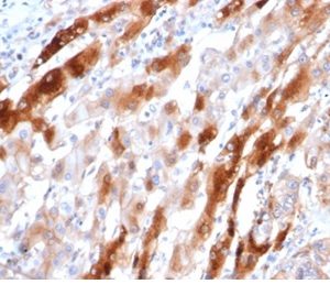 Formalin-fixed, paraffin-embedded human liver stained with Glutamine Synthetase Mouse Monoclonal Antibody (GLUL/6604) at 2ug/ml. HIER: Tris/EDTA, pH9.0, 45min. 2 °: HRP-polymer, 30min. DAB, 5min.
