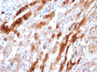 Formalin-fixed, paraffin-embedded human liver stained with Glutamine Synthetase Mouse Monoclonal Antibody (GLUL/6604) at 2ug/ml. HIER: Tris/EDTA, pH9.0, 45min. 2°C: HRP-polymer, 30min. DAB, 5min.