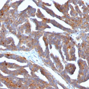 Formalin-fixed, paraffin-embedded human Ovarian Tumor stained with GnRH-Receptor Mouse Monoclonal Antibody (F1G4).