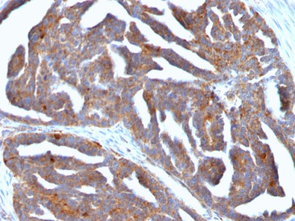 Formalin-fixed, paraffin-embedded human Ovarian Tumor stained with GnRH-Receptor Mouse Monoclonal Antibody (F1G4).
