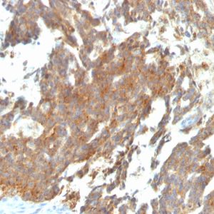 Formalin-fixed, paraffin-embedded human Ovarian Tumor stained with GnRH-Receptor Mouse Monoclonal Antibody (GNRHR/768).