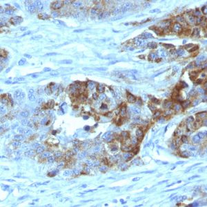 Formalin-paraffin human Colon Carcinoma stained with Blood Group Antigen H Type 2 MAb (19-OLE)