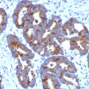 Formalin-fixed, paraffin-embedded human Colorectal Carcinoma stained with Blood Group Antigen A Monoclonal Antibody (HE-10)