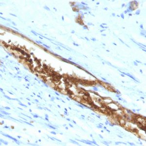 Formalin-paraffin human Colon Carcinoma stained with Blood Group Antigen A Mouse Monoclonal Antibody (3-3A).