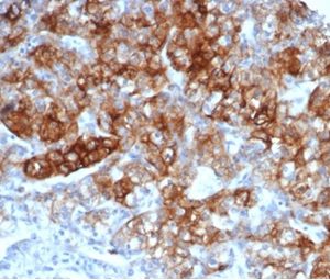 Formalin-fixed, paraffin-embedded human kidney carcinoma stained with CD13 Mouse Monoclonal Antibody (APN/6997) at 2ug/ml. HIER: Tris/EDTA, pH9.0, 45min. 2 °: HRP-polymer, 30min. DAB, 5min.