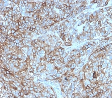 Formalin-fixed, paraffin-embedded human breast carcinoma stained with PD-L1 Recombinant Mouse Monoclonal Antibody (rPDL1/4772). HIER: Tris/EDTA, pH9.0, 45min. 2°C: HRP-polymer, 30min. DAB, 5min.