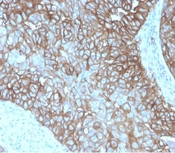 Formalin-fixed, paraffin-embedded human breast carcinoma stained with PD-L1 Recombinant Mouse Monoclonal Antibody (rPDL1/4772). HIER: Tris/EDTA, pH9.0, 45min. 2°C: HRP-polymer, 30min. DAB, 5min.