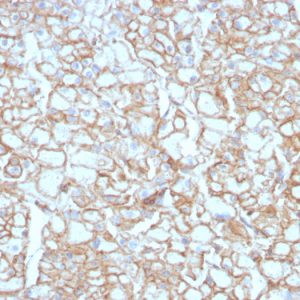 Formalin-fixed, paraffin-embedded human Lung SqCC stained with PD-L1 Recombinant Rabbit Monoclonal Antibody (PDL1/4451R).