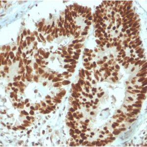 Formalin-fixed, paraffin-embedded human Colon Carcinoma stained with MSH6 Mouse Monoclonal Antibody (MSH6/3091).