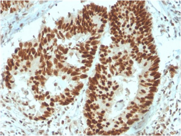 Formalin-fixed, paraffin-embedded human Colon Carcinoma stained with MSH6 Mouse Monoclonal Antibody (MSH6/3091).