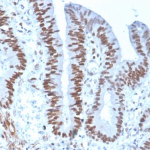 Formalin-fixed, paraffin-embedded human colon carcinoma stained with MSH6 Recombinant Mouse Monoclonal Antibody (rMSH6/4743).