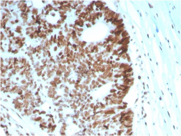 Formalin-fixed, paraffin-embedded human Colon Carcinoma stained with MSH6 Mouse Monoclonal Antibody (MSH6/2927).