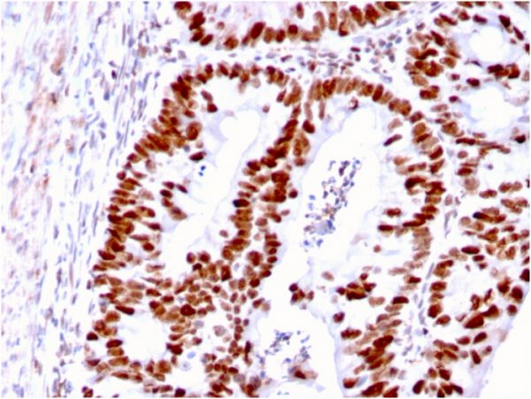 Formalin-fixed, paraffin-embedded human Colon Carcinoma stained with MSH6 Mouse Monoclonal Antibody (MSH6/3085).