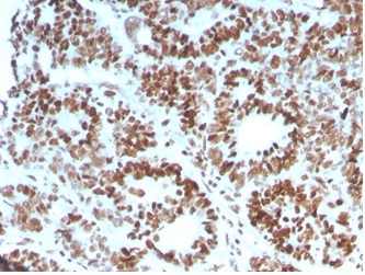 Formalin-fixed, paraffin-embedded human colon carcinoma stained with MSH6 Mouse Monoclonal Antibody (MSH6/3086).