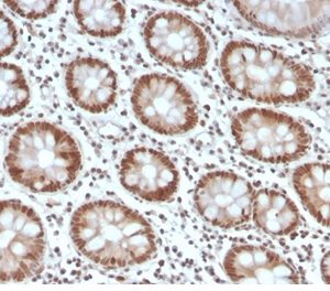 Formalin-fixed, paraffin-embedded human colon stained with MSH6 Recombinant Rabbit Monoclonal Antibody (MSH6/4592R).