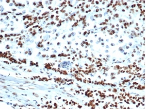 Formalin-fixed, paraffin-embedded human colon carcinoma stained with MSH6 Recombinant Rabbit Monoclonal Antibody (MSH6/6654R).