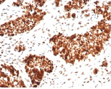 Formalin-fixed, paraffin-embedded human ovarian carcinoma stained with MSH6 Recombinant Rabbit Monoclonal Antibody (MSH6/7065R).