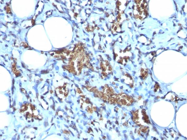 Formalin-fixed, paraffin-embedded human Angiosarcoma stained with Glycophorin A Mouse Monoclonal Antibody (GYPA/280).
