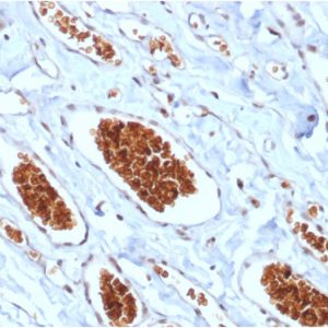 Formalin-fixed, paraffin-embedded human Angiosarcoma stained with Glycophorin A Mouse Recombinant Monoclonal Antibody (rGYPA/280).