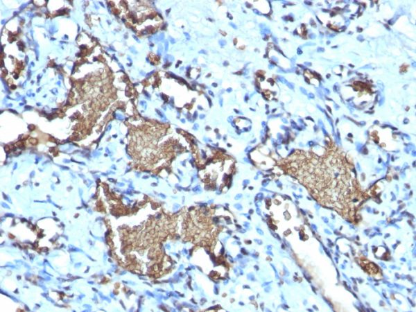 Formalin-fixed, paraffin-embedded human Angiosarcoma stained with Glycophorin A Rabbit Recombinant Monoclonal Antibody (GYPA/1725R).