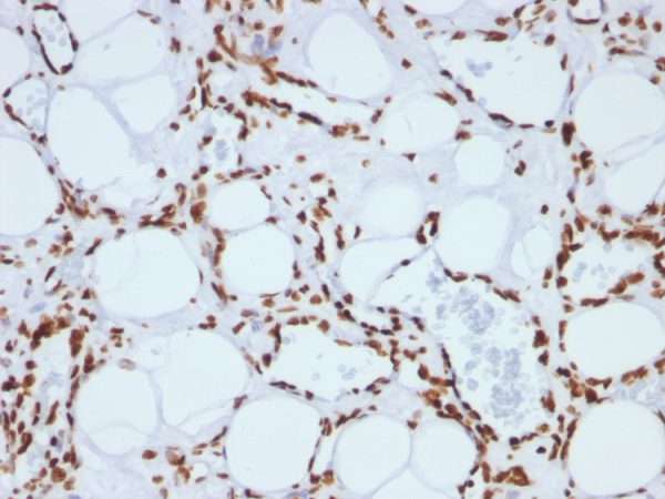 Formalin-fixed, paraffin-embedded human Angiosarcoma stained with Histone H1 Monoclonal Antibody (SPM256).