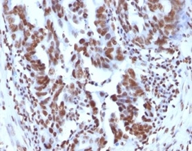 Formalin-fixed, paraffin-embedded human ovarian carcinoma stained with Histone H1 Mouse Monoclonal Antibody (1415-1).