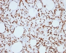 Formalin-fixed, paraffin-embedded human angiosarcoma stained with Histone H1 Mouse Monoclonal Antibody (1415-1).