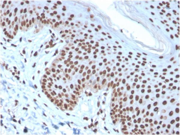 Formalin-fixed, paraffin-embedded human Basal Cell Carcinoma stained with Histone H1 Mouse Recombinant Monoclonal Antibody (rAE-4).