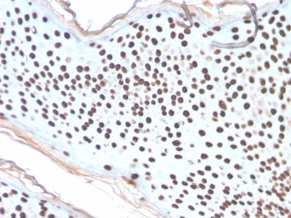 Formalin-fixed, paraffin-embedded human Skin Basal Cell Carcinoma stained with Histone H1 Rabbit Recombinant Monoclonal Antibody (AE-4).