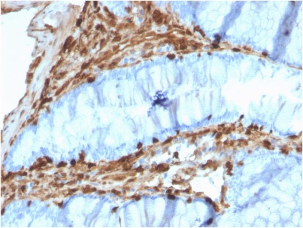 Formalin-fixed, paraffin-embedded human Colon Carcinoma stained with Annexin A1 Mouse Monoclonal Antibody (CPTC-ANXA1-1).