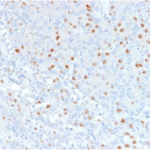 Formalin-fixed, paraffin-embedded human Bladder Carcinoma stained with Annexin A1 Mouse Monoclonal Antibody (6E4/3).