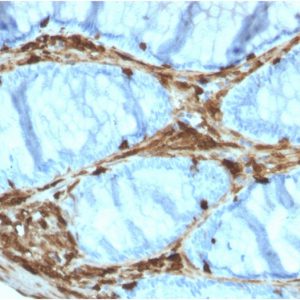 Formalin-fixed, paraffin-embedded human Colon Carcinoma stained with Annexin A1 Mouse Monoclonal Antibody (ANXA1/3566).