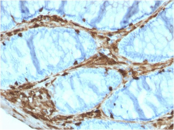 Formalin-fixed, paraffin-embedded human Colon Carcinoma stained with Annexin A1 Mouse Monoclonal Antibody (ANXA1/3566).