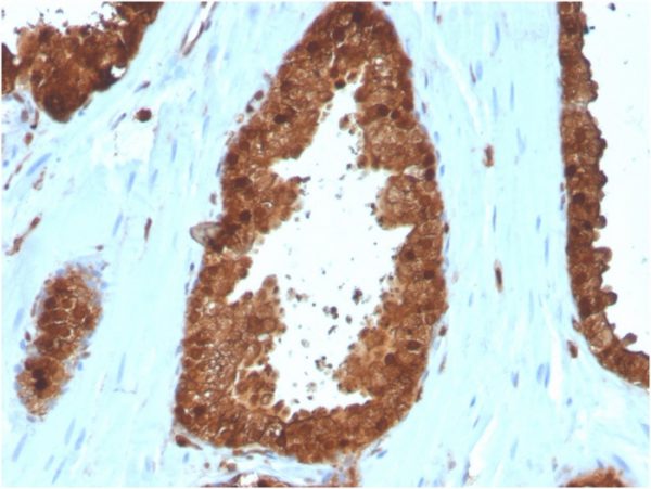 Formalin-fixed, paraffin-embedded human Prostate Carcinoma stained with Annexin A1 Mouse Monoclonal Antibody (ANXA1/3566).