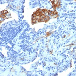 Formalin-fixed, paraffin-embedded human Lung Carcinoma stained with CD209 Mouse Monoclonal Antibody (C209/1781).