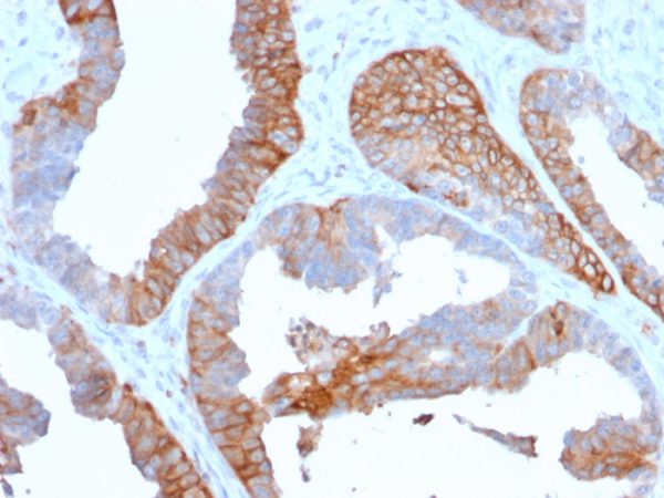 Formalin-fixed, paraffin-embedded human Prostate Carcinoma stained with HLA-DR Mouse Monoclonal Antibody (TAL 1B5).