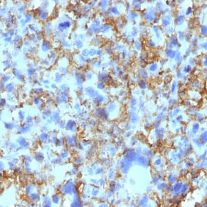 Formalin-fixed, paraffin-embedded human Histiocytoma stained with HLA-DR Monoclonal Antibody (LN-3).