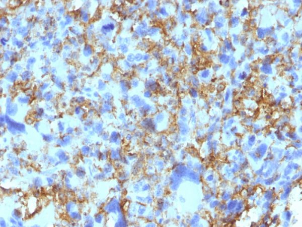 Formalin-fixed, paraffin-embedded human Histiocytoma stained with HLA-DR Monoclonal Antibody (LN-3).