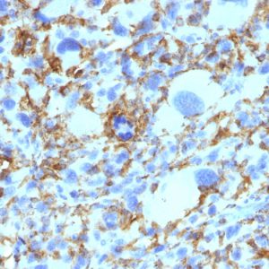 Formalin-fixed, paraffin-embedded human Histiocytoma stained with HLA-DR Monoclonal Antibody (SPM423).