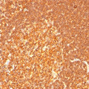 Formalin-fixed, paraffin-embedded human Tonsil stained with HLA-DR Monoclonal Antibody (LN-3 + HLA-DRB/1067).