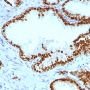 Formalin-fixed, paraffin-embedded human Prostate Carcinoma stained with FOXA1 Monoclonal Antibody (FOXA1/1241).