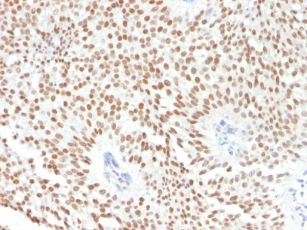 Formalin-fixed, paraffin-embedded human Bladder Carcinoma stained with FOXA1 Monoclonal Antibody (FOXA1/1241).