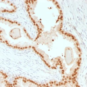 Formalin-fixed, paraffin-embedded human Prostate Carcinoma stained with FOXA1 Mouse Recombinant Monoclonal Antibody (rFOXA1/1515).