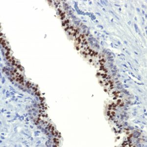Formalin-fixed, paraffin-embedded human Prostate Carcinoma stained with FOXA1  Monoclonal Antibody (FOXA1/1514).