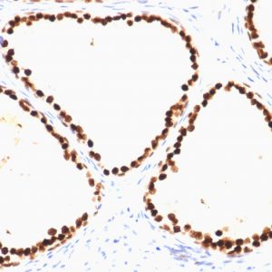 Formalin-fixed, paraffin-embedded human Prostate Carcinoma stained with FOXA1 Mouse Monoclonal Antibody (FOXA1/1515).