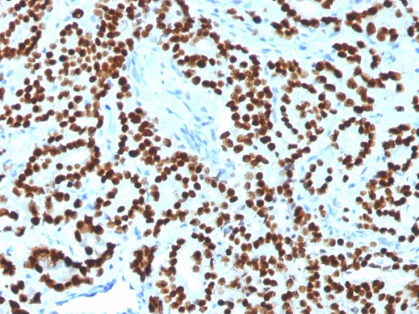 Formalin-fixed, paraffin-embedded human Prostate Carcinoma stained with FOXA1 Monoclonal Antibody (FOXA1/1518).