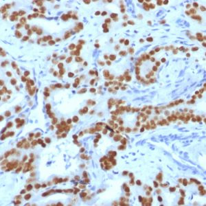 Formalin-fixed, paraffin-embedded human prostate carcinoma stained with FOXA1 Mouse Monoclonal Antibody (FOXA1/1519).