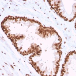 Formalin-fixed, paraffin-embedded human Prostate Carcinoma stained with APEX Nuclease I Mouse Monoclonal Antibody (CPTC-APEX1-2).