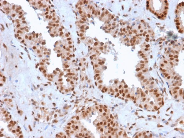 Formalin-fixed, paraffin-embedded human Prostate Carcinoma stained with APEX Nuclease I Mouse Monoclonal Antibody (CPTC-APEX1-2).